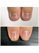 ウェルズユキ(well's yuki)/噛み爪　むしり爪