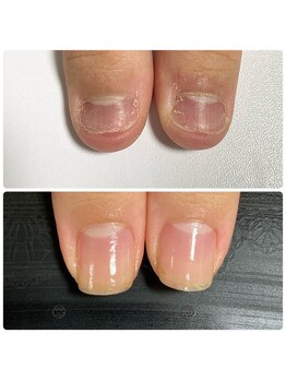 ウェルズユキ(well's yuki)/噛み爪 むしり爪