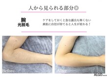 アルゴ 豊中岡町駅前店(ALGO)/【腕】自己処理頻度の最多箇所