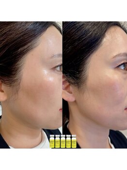 スプレール 水戸店/夢のような小顔エステ