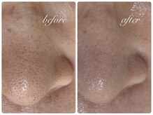 アリスビューティー(AliceBeauty)/毛穴の黒ずみ＆詰まり撃退コース