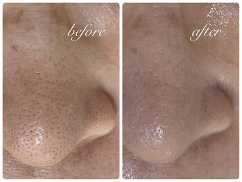 アリスビューティー(AliceBeauty)/毛穴の黒ずみ＆詰まり撃退コース