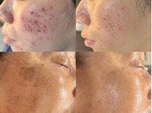 【結果重視ハーブピーリング】肌土台から生まれ変わり根本改善