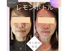 レモンボトルで終わりのある脂肪分解！シャープなフェイスライン