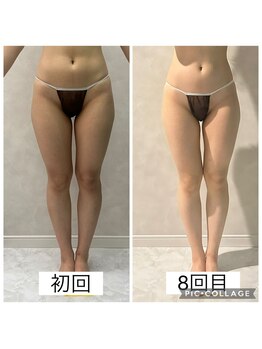 エクラ(Eclat)/Eclatの痩身★before/after16