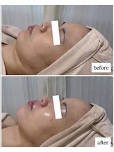 エムイーボーテ(me.Beaute)/【セルマン】むくみ改善！小顔に