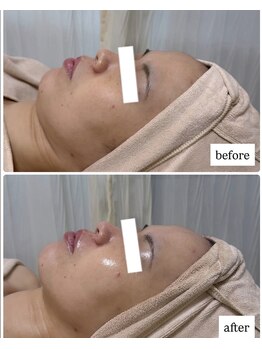 エムイーボーテ(me.Beaute)/【セルマン】むくみ改善！小顔に