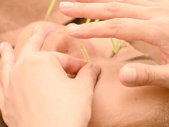 三和旭が丘院/眼精疲労美容鍼