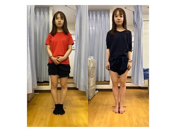 キュア整骨院(CURE整骨院)/Ｏ脚矯正コース実績２