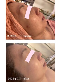 小顔クイーン 荻窪店/リゼネレートで圧倒的な美肌へ