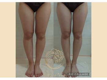 カロニア(CaLoNia)/骨格×脂肪アプローチ