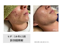 ザ エッセンシャル 碧南(THE Essential)/にきび・カミソリ負けケア