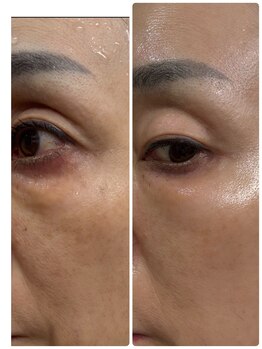 ジュエルビューティー(Jewel Beauty)/リセラADS肌改善