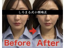 アベックトア(Avectoi)/フェイスラインを変えて小顔に