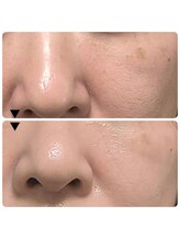 アイドット(i...)/フェイシャルビフォーアフター♪