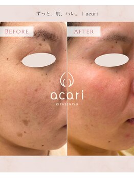アカリ(acari)の写真/長年のシミ悩みに終止符を！諦めない心に寄り添い、塗るシミケアで理想の透明感へ導きます♪