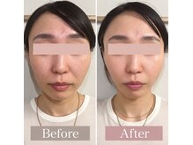 カヤ(KAYA)の雰囲気（ヒト幹細胞上清液導入、くすみ、開き毛穴、肌の凹凸も滑らかに）