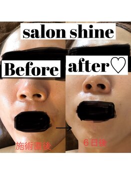 サロンシャイン(Salon Shine)/ハーバルピールレベル７