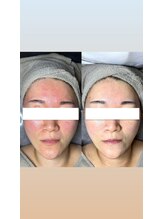 エムアンドエム(M&M)/肌質改善