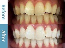 アース 岡崎店(EARTH)/ 【ビフォーアフター】美白