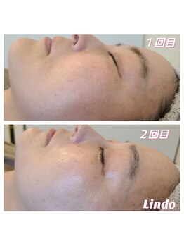 リンド(Lindo)/WiQo水光ピール