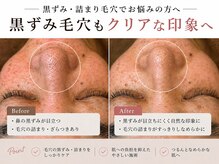 スコビ(SUKOBI)の雰囲気（50代のしつこい黒ずみもスッキリと！）