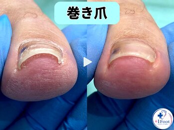 プラスワンフット 本厚木(+1 Foot)/巻き爪矯正は専門店へ●