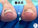 巻き爪矯正は専門店へ●