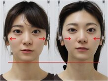 さつま骨格矯正 HRD広尾 西麻布院 /歪み小顔矯正 BeforeAfter