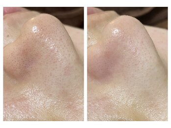 ドリーム(dRe:am)/新メニュー☆毛穴ケア