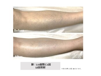 中国整体リラクゼーション 桜月/女性の脚脱毛