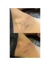 【ワキ脱毛卒業！】夏まだ間に合う！Wでおトク◎WAX脱毛＋光脱毛　通常8500円