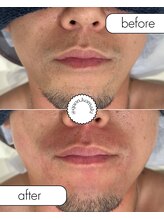 久遠(クオン)/メンズ　ヒゲ脱毛　2025/9/20