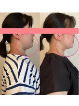 カラダミックス(karadamix)/フェイスラインのたるみ改善