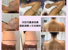 中部地区初！脂肪減少リフトでリバウンドしにくい体づくり！