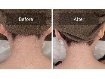 モナ 宝塚店(Mona)/うなじワックス脱毛