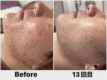 エフプラネット(F Planet)/15万本スピキュールピーリング