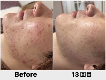 エフプラネット(F Planet)/15万本スピキュールピーリング