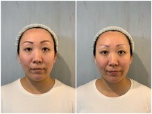 激的BeforeAfterの小顔技術を提供/コルギ/タルミ改善/美白/毛穴