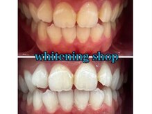 ホワイトニングショップ 鳥取店/ホワイトニングビフォーアフター