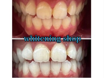 ホワイトニングショップ 鳥取店/ホワイトニングビフォーアフター