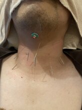 リノア鍼灸院(LINOA)/喉の違和感の鍼灸施術