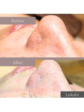 ロカヒ(Lokahi)/毛穴洗浄で開き毛穴改善☆