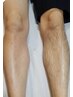 【男性部分脱毛】¥3300~
