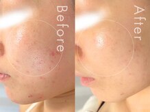 セルフミー 恵比寿(SELF Me...)/ハーブピーリング/毛穴ケア