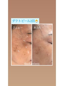 ノフ 恵比寿(noff)/bf/af【ダクトピール】