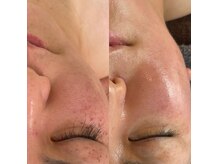 ナル(naru.)の雰囲気(1回目~6回目の経過です。幹細胞ダブルも効果大。)