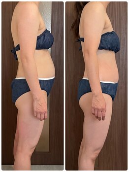 サルサナ(Salu Sana)/ぽっこりお腹は内臓脂肪！