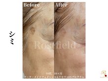 ローズフィールド(Rosefield)/RFピール/フェイシャル/シミ毛穴