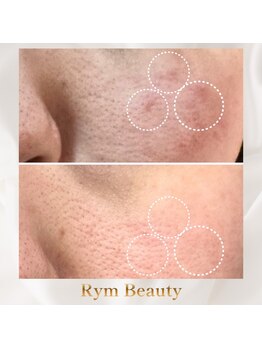 リム ビューティー(RYM BEAUTY)/お肌のシミ、くすみ、毛穴ケアに